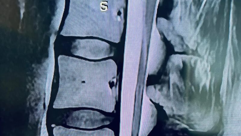 Some say stem cell treatments eliminated their pain