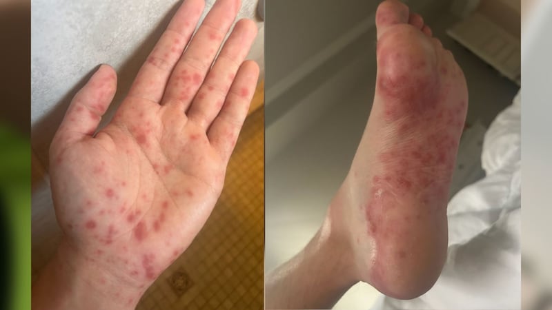 Highly contagious Hand-Foot-Mouth virus spreading in Middle Tennessee